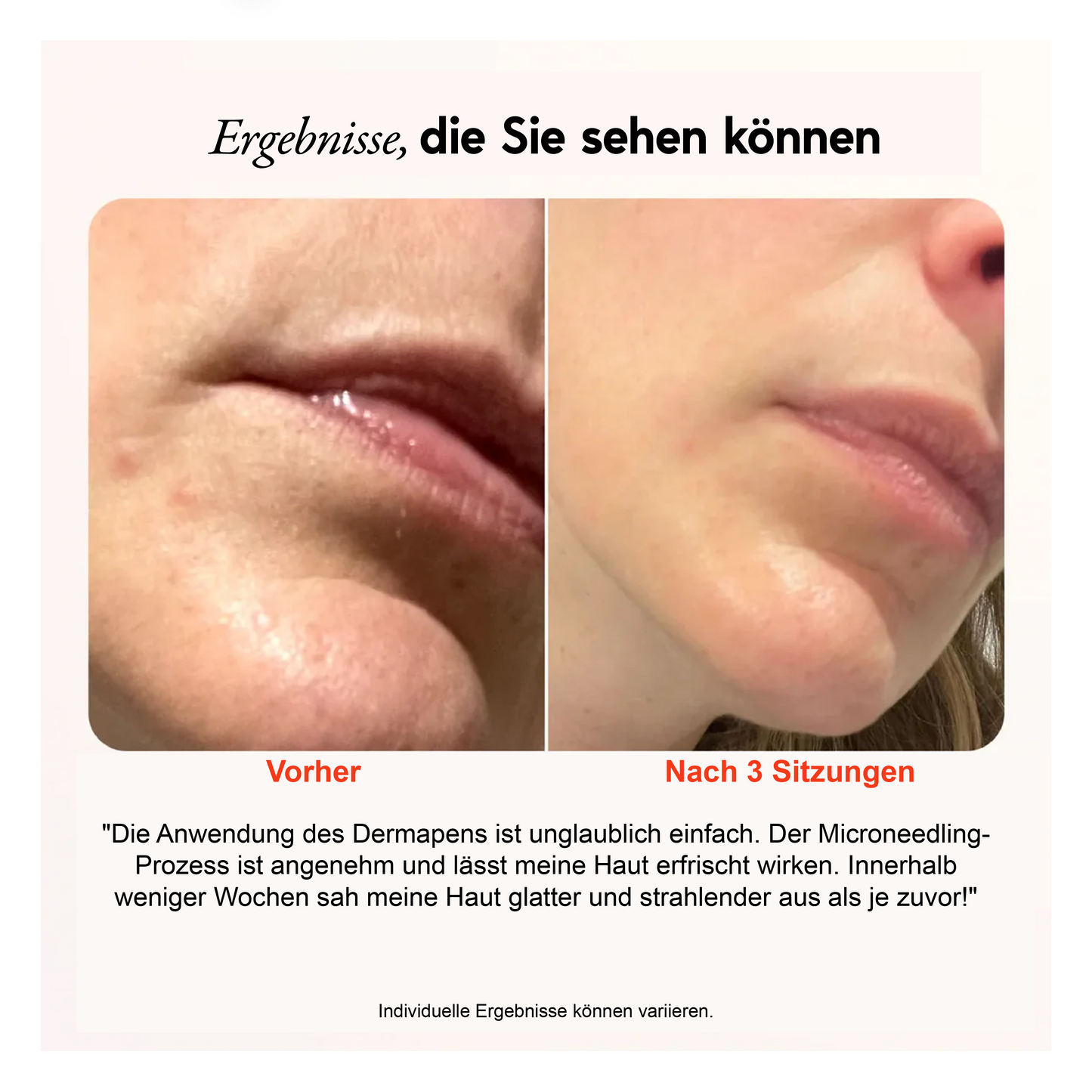 Wiederaufladbarer Microneedling Dermapen Pro mit 30 Ersatzpatronen